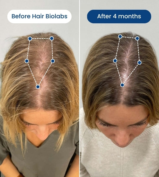 Clinical Regrowth Micro-infusion system