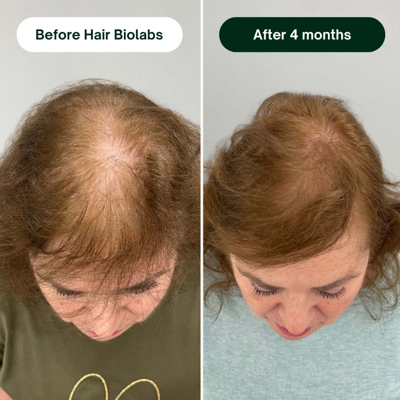 Hair Biolabs - Hair Regrowth System
