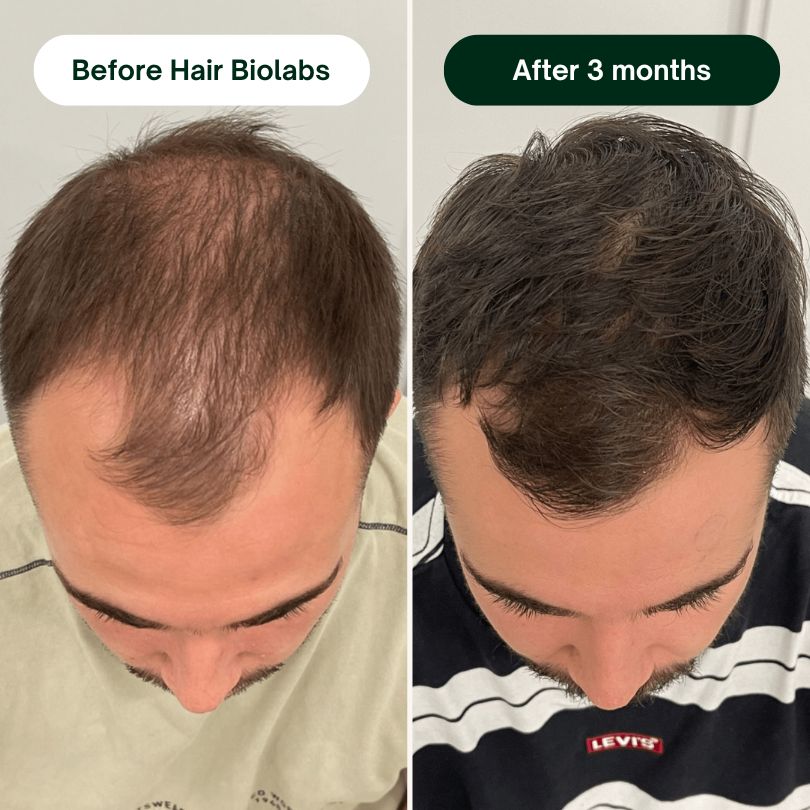 Hair Biolabs™ Hair Regrowth Micro-Infusion System