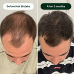 Hair Biolabs™ Hair Regrowth Micro-Infusion System