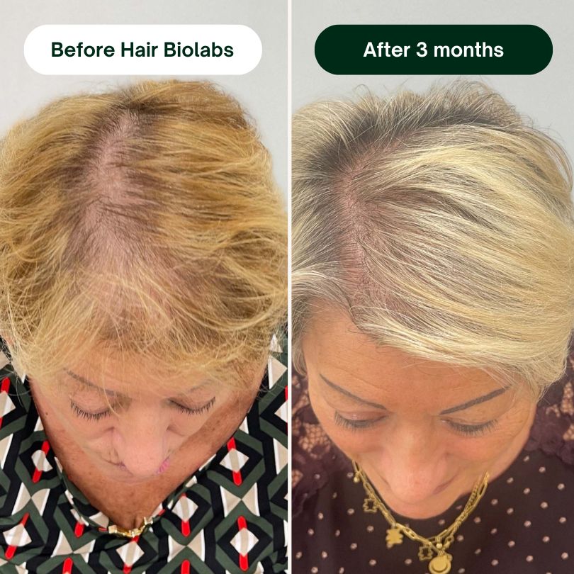 Hair Biolabs REDENSIFY™ - Stops Hair Loss in 21 Days