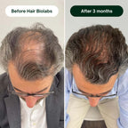 Hair Biolabs™ Hair Regrowth Micro-Infusion System