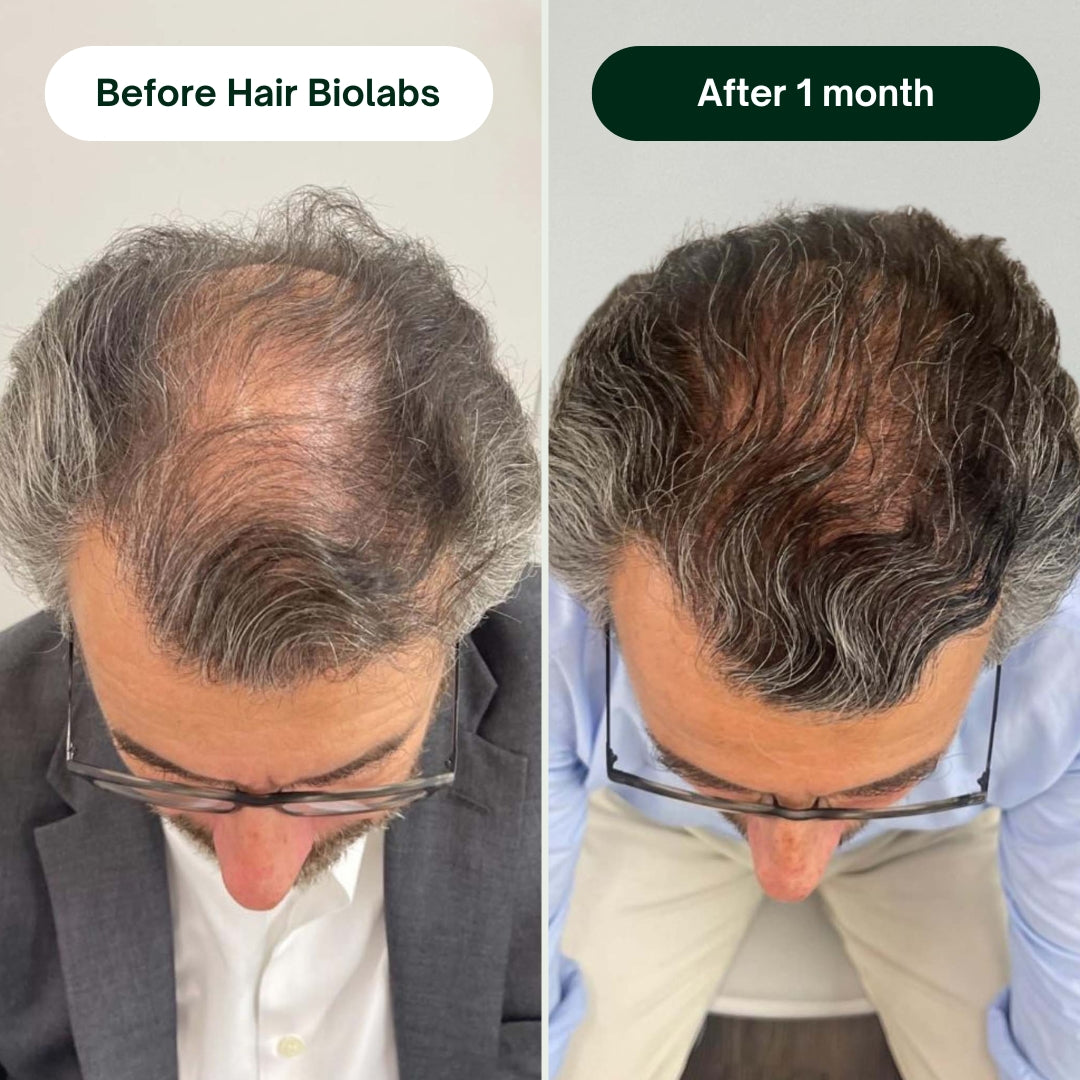 Hair Biolabs Hair Regrowth Micro-Infusion System