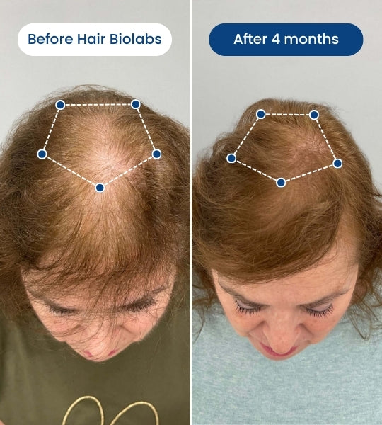 Clinical Regrowth Micro-infusion system